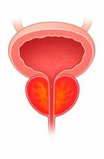 Prostatako guruinaren hantura