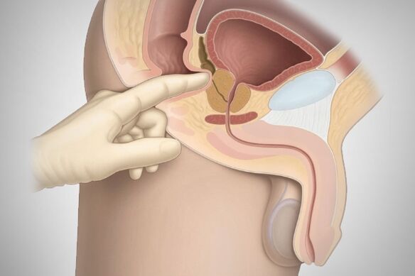 Prostatako masajea bakterioen prostatitisetarako